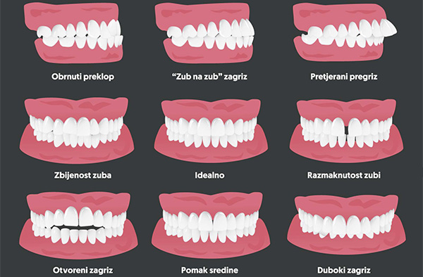 Prikaz različitih oblika zagriza zuba, nepravilnih i pravilnih, koje korigiramo kod naših stručnjaka za ortodonciju u klinici MB dent u Zagrebu.