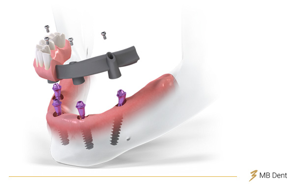 Ilustracija Straumann Pro Arch (all-on-4) metode ugradnje implantanata u MB dent klinici u Zagrebu.