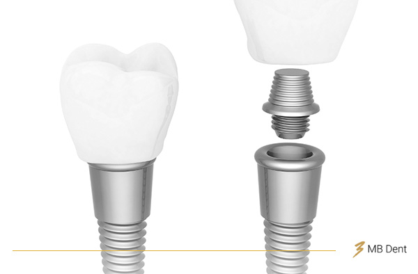 Slika zubnog implantata i sva 3 dijela od kojih se sastoji.