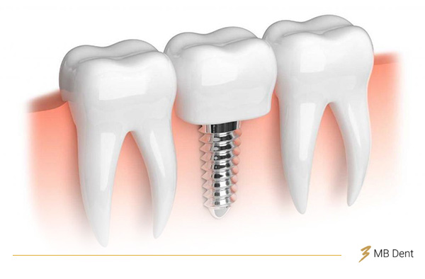 Slika zubnog implantata i pozicije prilikom ugradnje u kost.