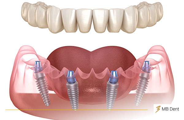 Vizualizacija ugradnje implantata metodom all-on-4 u klinici MB dent koja se nalazi u Zagrebu.